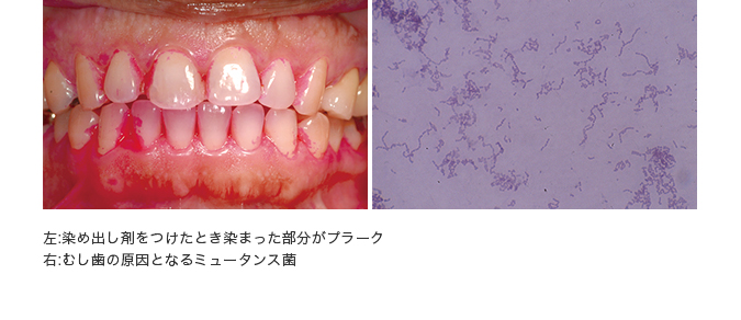 左：染め出し剤をつけたとき染まった部分がプラーク、右：むし歯の原因となるミュータンス菌